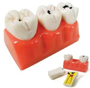 A543 Dientes con desarrollo de caries, 3 etapas, 4x tamaño natural, 7 piezas.
