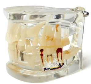 PRA-A548-1 Modelo de denición de dientes patológicos transparentes.