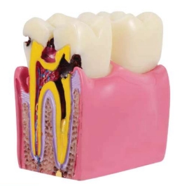 A546 Modelo de comparación de caries dental, 6x tamaño real.