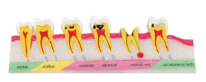 A549 Modelo de desarrollo de caries decaimental.