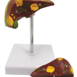 A754 Modelo patológico del hígado, 2 piezas.