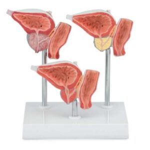 A773 Glándula prostática normal y enferma, 3 piezas.