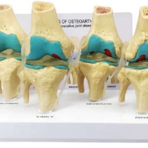 A747 Modelo de articulación de rodilla degenerativa de 4 etapas, 4 piezas.